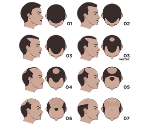 What is The Hamilton-Norwood Scale?
