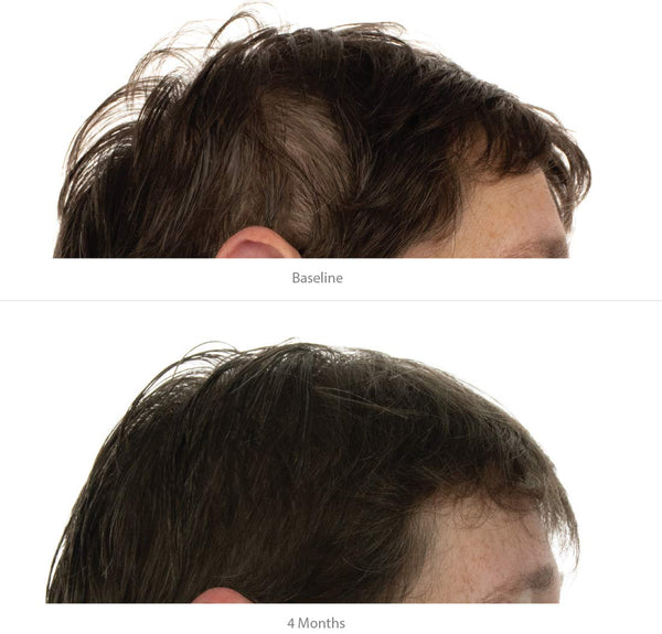 FOLIGAIN Hair Growth Shampoo + Conditioner Kit For Women