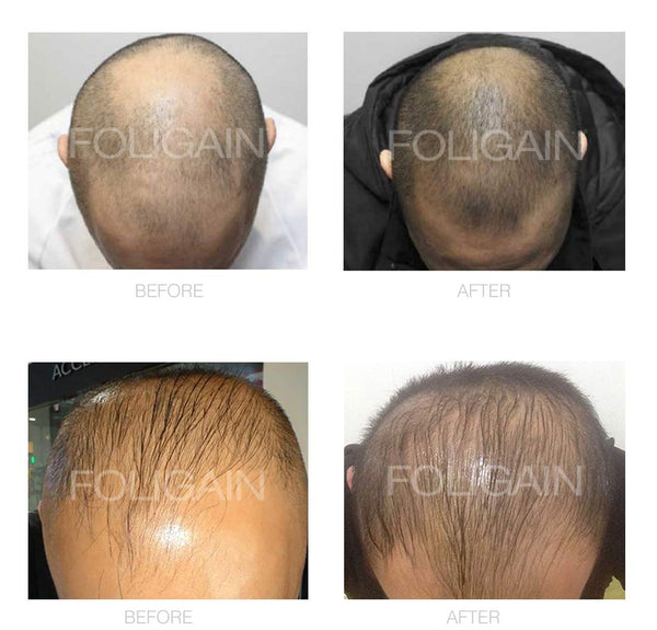 FOLIGAIN Low Alcohol Minoxidil 5% Hair Regrowth Treatment For Men 12 Month Supply