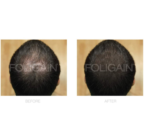 FOLIGAIN Low Alcohol Minoxidil 5% Hair Regrowth Treatment For Men 6 Month Supply