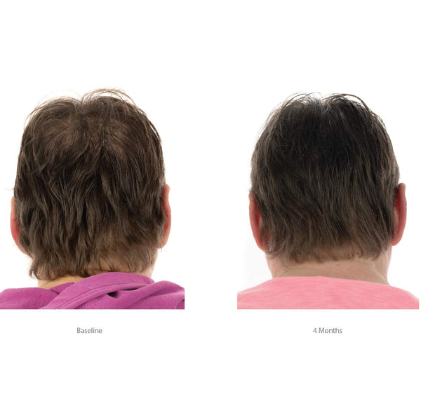 FOLIGAIN Women's Hair Regrowth Kit