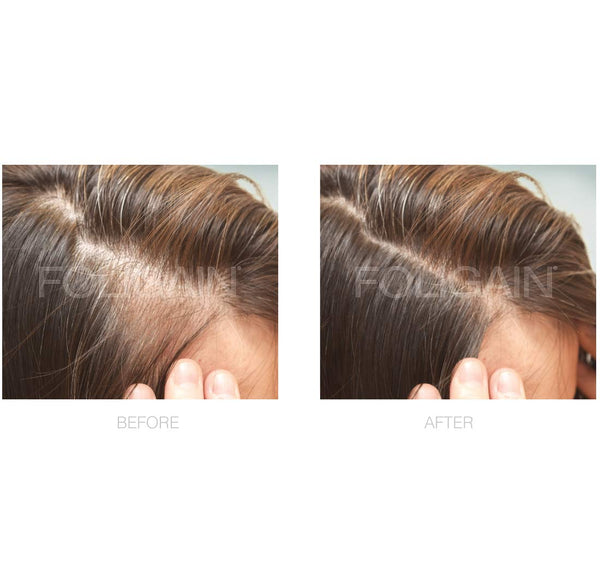 FOLIGAIN Minoxidil 2% Hair Regrowth Treatment For Women 6 Month Supply